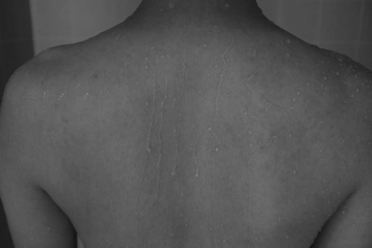 Eczema and Dermatitis Skincare Guide: Calm Flare-Ups and Protect Your Barrier